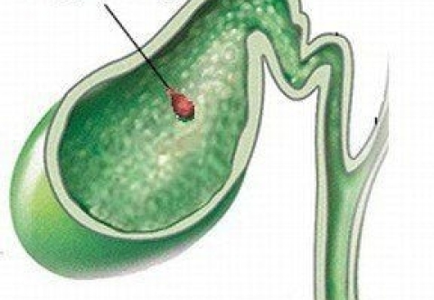 Polyp túi mật là gì