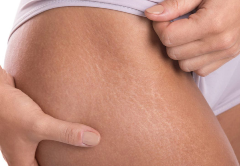 Cải thiện các bệnh lý về da sau phẫu thuật nội soi thu nhỏ dạ dày 