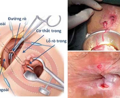 Hướng dẫn chăm sóc sau mổ rò hậu môn