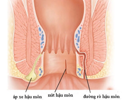 Áp xe hậu môn có liên quan gì đến rò hậu môn?