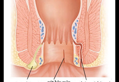 Áp xe hậu môn có liên quan gì đến rò hậu môn?