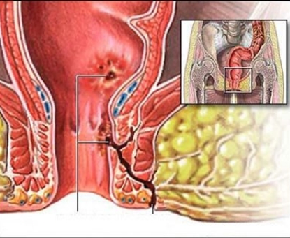 Rò hậu môn có tự khỏi không, và cách xử lý ban đầu tại nhà