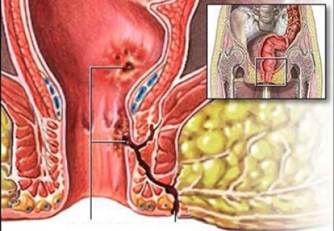 Rò hậu môn có tự khỏi không, và cách xử lý ban đầu tại nhà