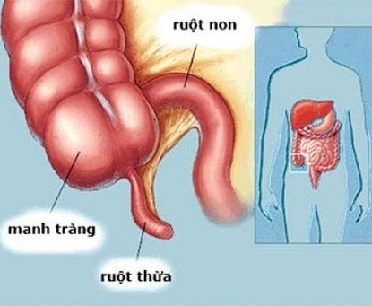 Hướng dẫn chăm sóc sau mổ cắt ruột thừa