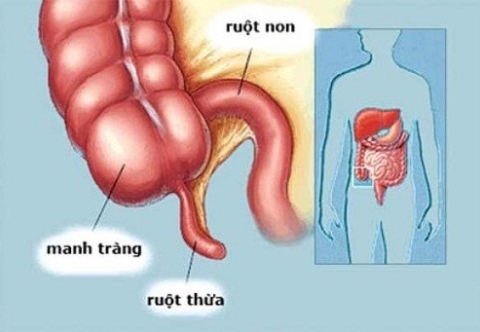 Hướng dẫn chăm sóc sau mổ cắt ruột thừa