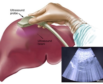 Ung thư gan có thể phát hiện thông qua các xét nghiệm hình ảnh nào?