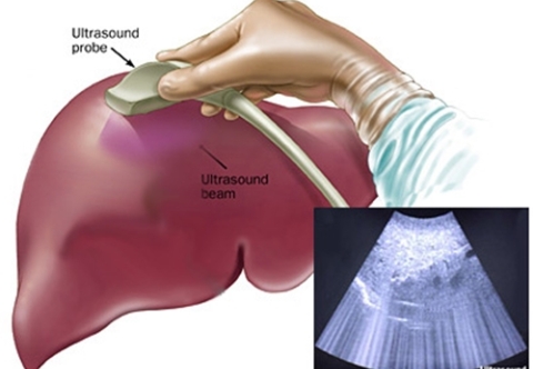 Ung thư gan có thể phát hiện thông qua các xét nghiệm hình ảnh nào?