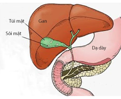 Phòng ngừa bệnh sỏi mật: Hướng dẫn chi tiết