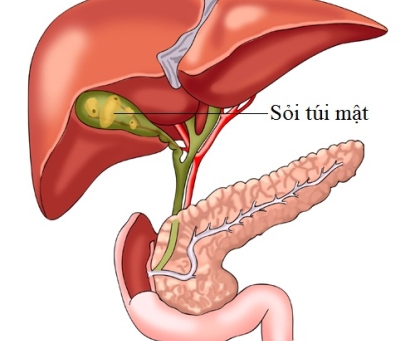 Sự khác nhau giữa giữa người Á Đông và người phương Tây về sỏi túi mật