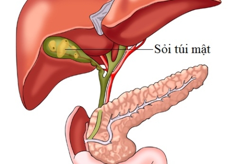Sự khác nhau giữa giữa người Á Đông và người phương Tây về sỏi túi mật