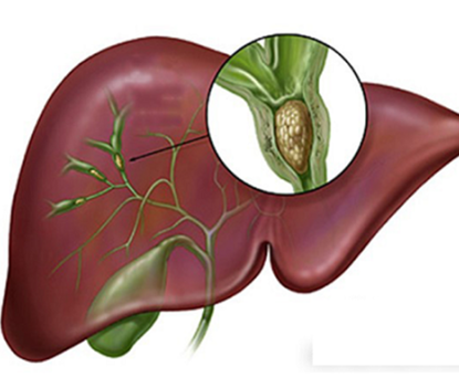 Nhận biết và chẩn đoán bệnh tắc mật do sỏi đường mật