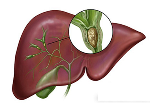 Nhận biết và chẩn đoán bệnh tắc mật do sỏi đường mật