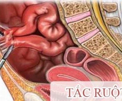 Phát hiện sớm và phương pháp điều trị bệnh tắc ruột