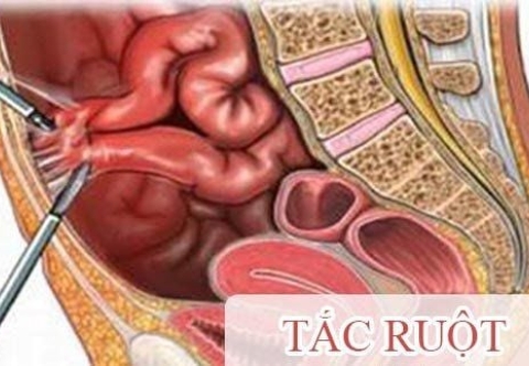 Phát hiện sớm và phương pháp điều trị bệnh tắc ruột