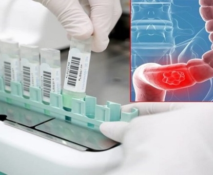 Tầm soát ung thư trực tràng bao gồm những bước nào và khi nào nên bắt đầu tầm soát?