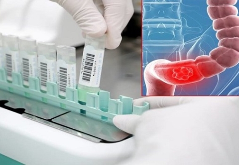 Tầm soát ung thư trực tràng bao gồm những bước nào và khi nào nên bắt đầu tầm soát?