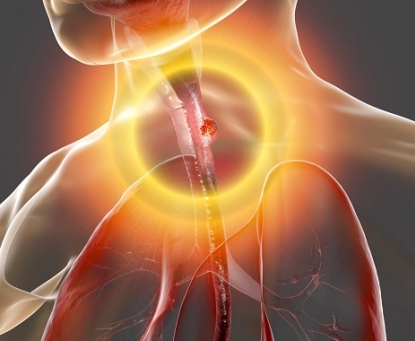 Béo phì và nguy cơ ung thư thực quản