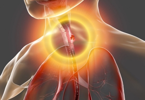 Béo phì và nguy cơ ung thư thực quản