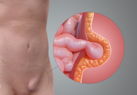 Các dấu hiệu thường gặp của thoát vị bẹn