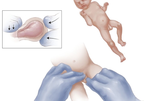 Thoát vị bẹn ở trẻ em có gì khác với người lớn