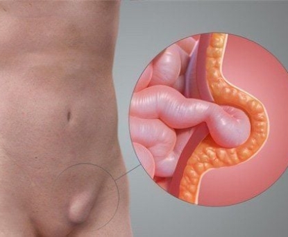 Thoát vị đùi có nguy hiểm không?