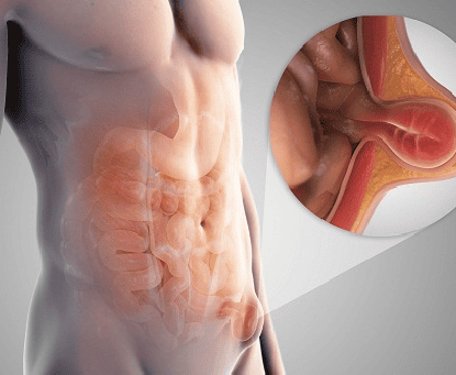 Khi nào cần khám bác sĩ nếu nghi ngờ bị thoát vị đùi?