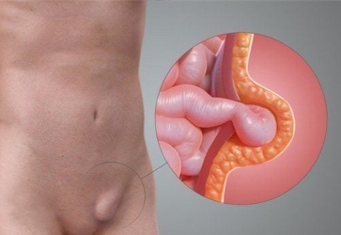 Thoát vị đùi có nguy hiểm không?