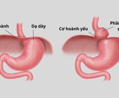 Bệnh thoát vị hoành và mối liên quan với trào ngược dạ dày thực quản