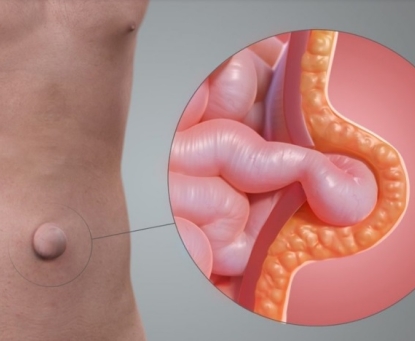 Cách nhận biết khối phồng vùng rốn là thoát vị rốn