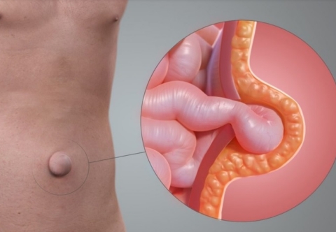 Cách nhận biết khối phồng vùng rốn là thoát vị rốn