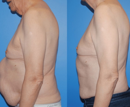 Khi nào khối phồng ở vết mổ trở nên nguy hiểm?