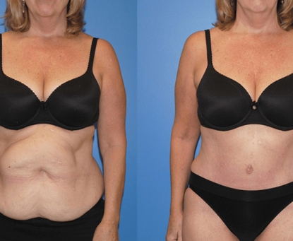 Cách nhận biết khối phồng ở vùng vết mổ có thể là thoát vị