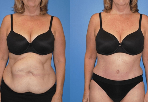 Hướng dẫn phòng ngừa thoát vị vết mổ