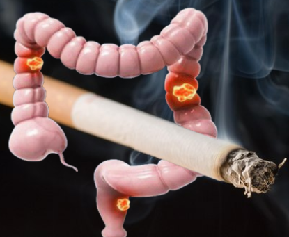Không sử dụng thuốc lá rượu bia giúp phòng ngừa ung thư trực tràng