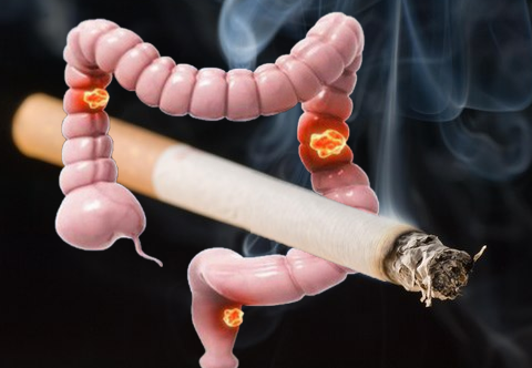 Không sử dụng thuốc lá rượu bia giúp phòng ngừa ung thư trực tràng