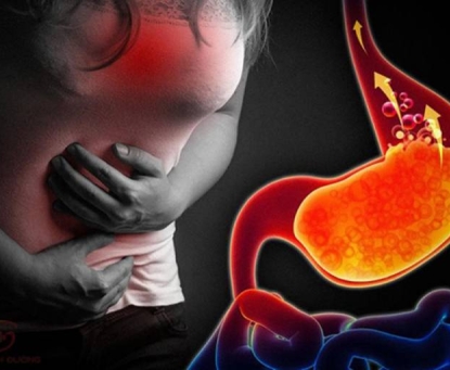 Mối liên quan giữa thừa cân béo phì và trào ngược dạ dày thực quản