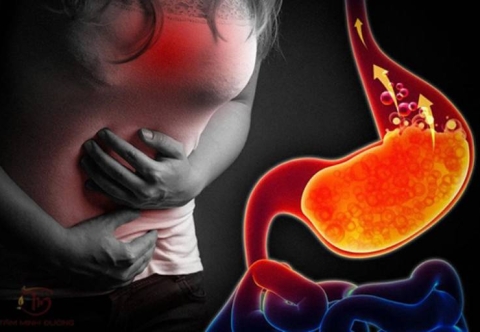 Mối liên quan giữa thừa cân béo phì và trào ngược dạ dày thực quản