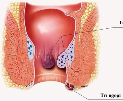 Dấu hiệu cảnh báo sớm bệnh trĩ