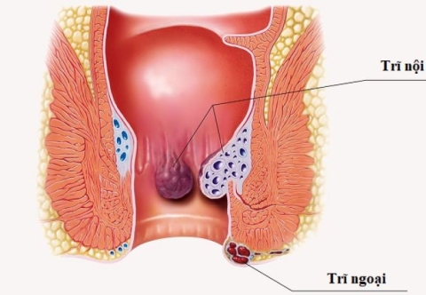 Dấu hiệu cảnh báo sớm bệnh trĩ