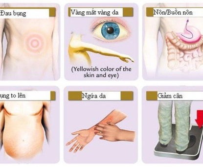 Khi nào nên đi khám bác sĩ nếu nghi ngờ mắc ung thư gan?