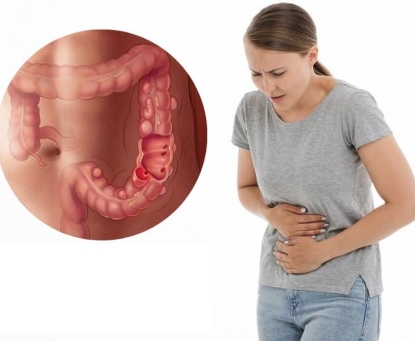 Vì sao người Á đông ít bị túi thừa đại tràng hơn người phương tây