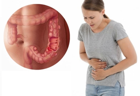 Vì sao người Á đông ít bị túi thừa đại tràng hơn người phương tây