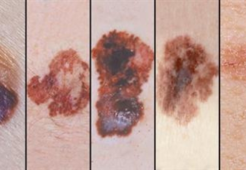 Liệu pháp tế bào cho u ác tính hắc tố (melanoma)