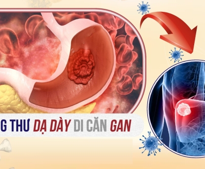 Ung thư dạ dày còn sống được bao lâu khi đã tái phát di căn