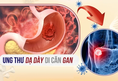 Ung thư dạ dày còn sống được bao lâu khi đã tái phát di căn