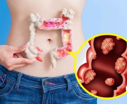 Ung thư đại tràng có thể điều trị khỏi không
