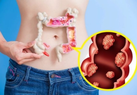 Ung thư đại tràng có thể điều trị khỏi không