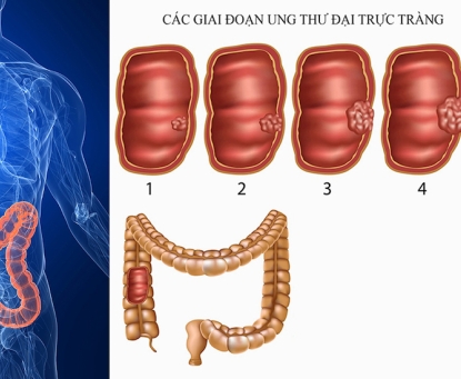 Kết quả điều trị và tiên lượng ung thư trực tràng