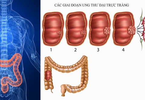 Kết quả điều trị và tiên lượng ung thư trực tràng