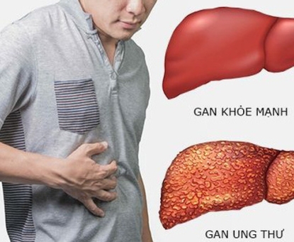 Tổng quan về ung thư gan 